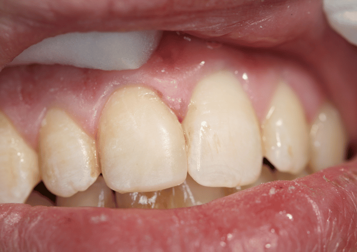 After - Colindale Dental