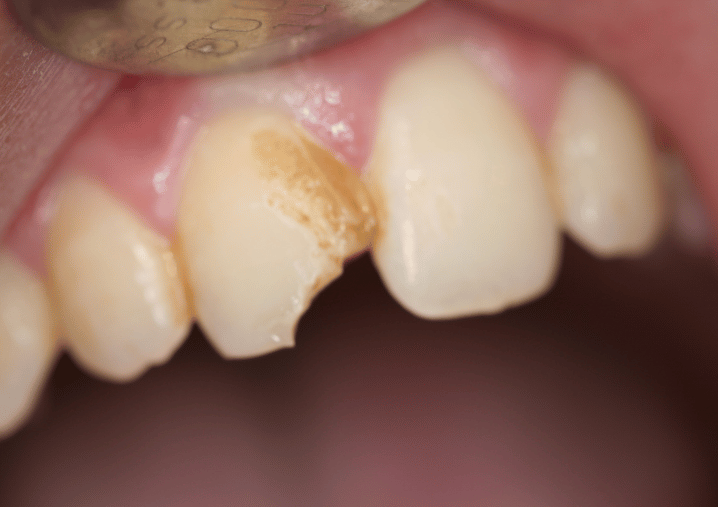 Before - Colindale Dental