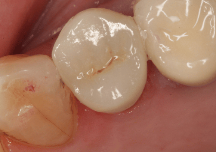 After - Colindale Dental