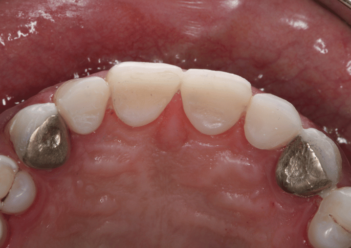 After - Colindale Dental