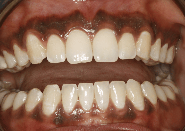After - Colindale Dental