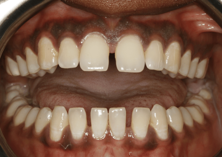 Before - Colindale Dental