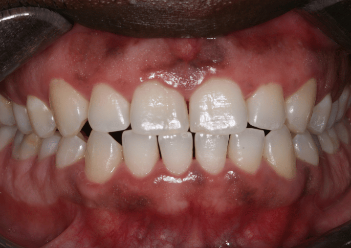 After - Colindale Dental