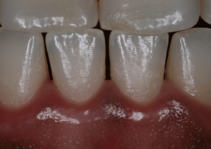 After - Colindale Dental