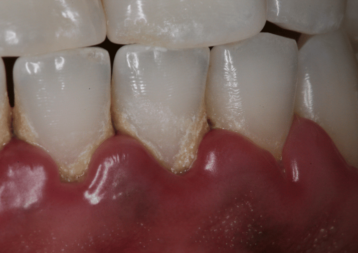 Before - Colindale Dental