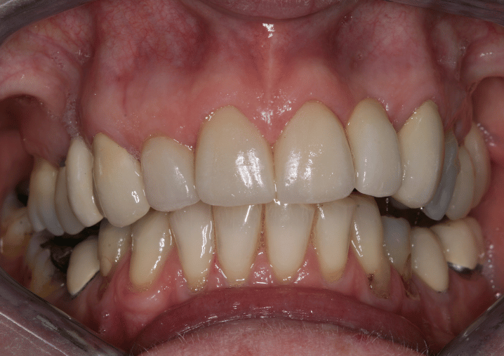 After - Colindale Dental