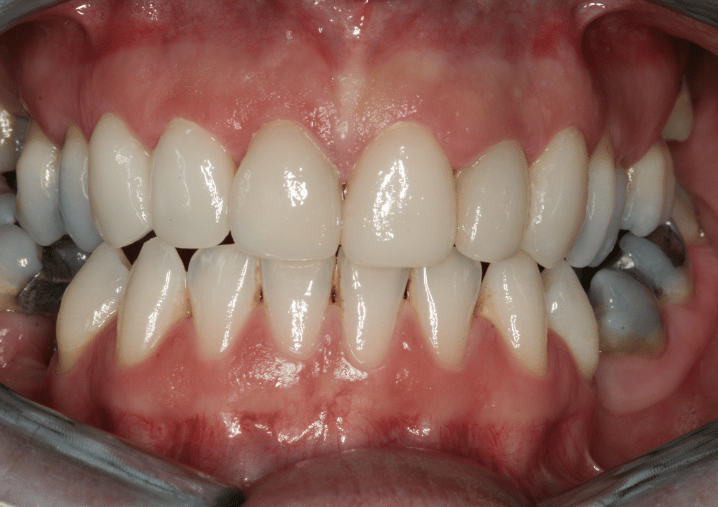 After - Colindale Dental