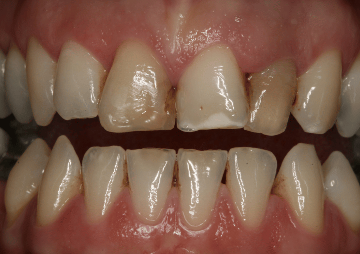 Before - Colindale Dental