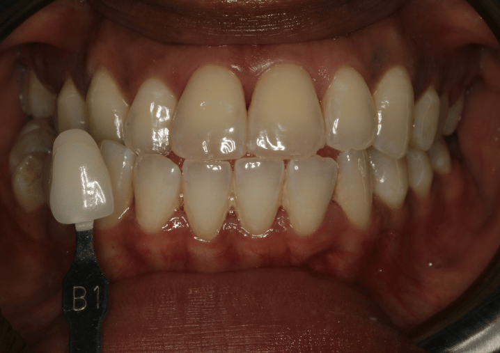 Before - Colindale Dental