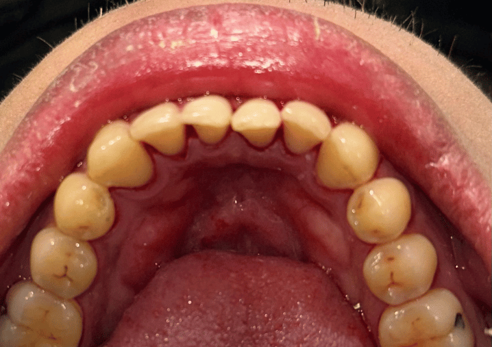 After - Colindale Dental