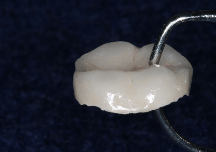 After - Colindale Dental