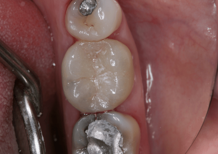 After - Colindale Dental