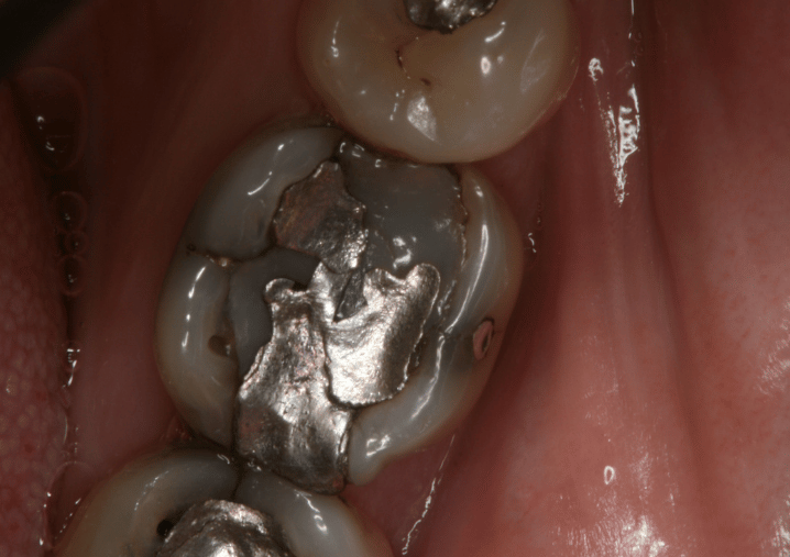 Before - Colindale Dental