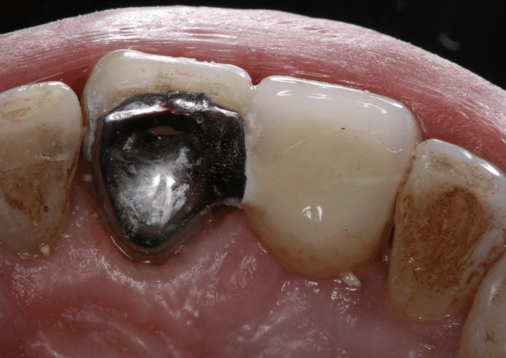 After - Colindale Dental