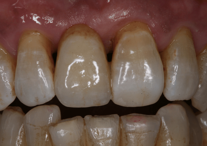 After - Colindale Dental