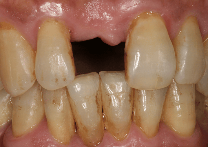Before - Colindale Dental